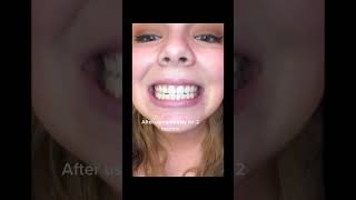 When You Try The Purple Foam Toothpaste And It Makes Your Teeth Look More Yellow