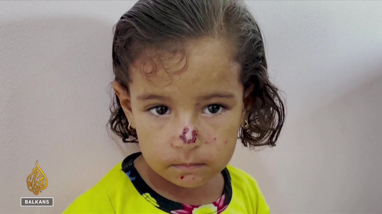 يتزايد عدد المصابين بأمراض جلدية في غزة