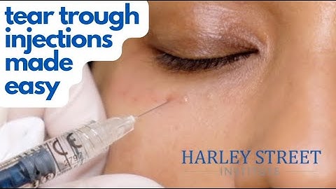 Instant Eye Lift: Watch a Tear Trough Filler Procedure almost live