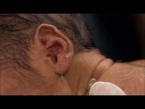 Skin Infection (Swahili) - Newborn Care Series