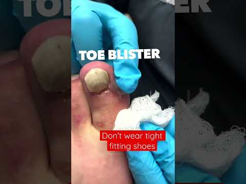 TIGHT FITTING SHOE CAUSES BLISTER