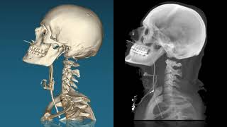 cervical spine trauma