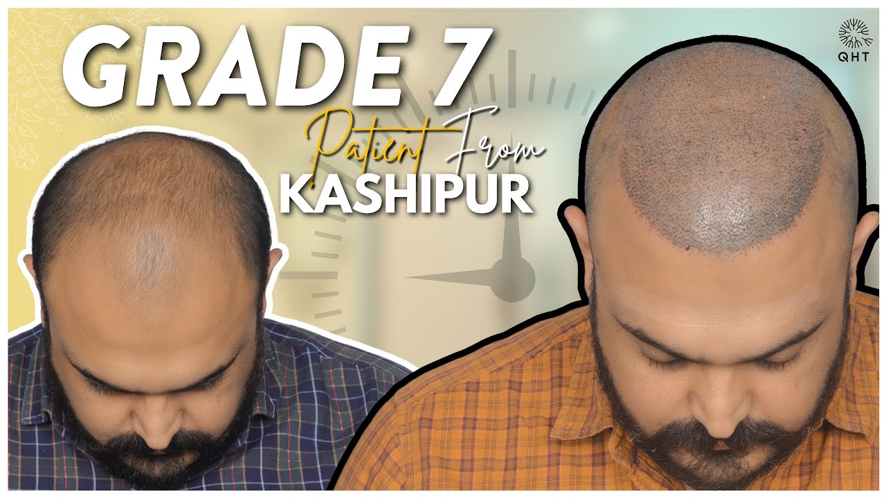 FUE Hair Transplant in Faridabad  View Cost  KDC Clinic