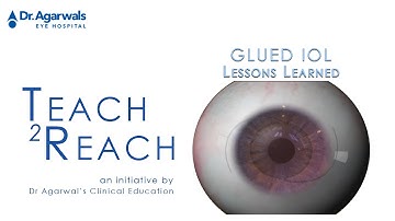 Glued IOL - Lessons Learned