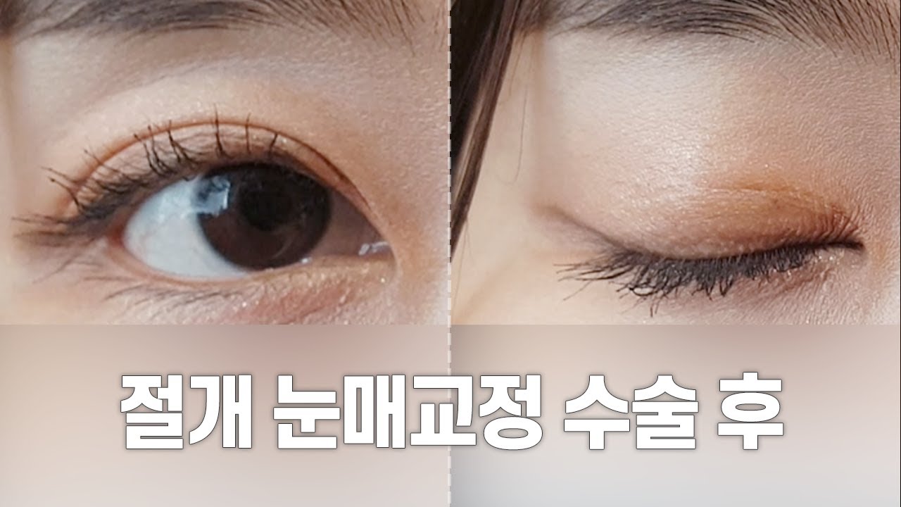 [Thẩm mỹ viện Gangnam Seoyeon] Video phẫu thuật/vết sẹo sau phẫu thuật chỉnh hình mắt cắt bỏ và cắt mí đôi l Thẩm mỹ viện Gangnam Seoyeon