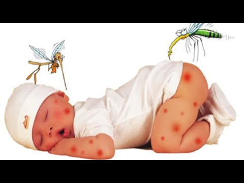 Video Nếu Em Bé , Trẻ Nhỏ Ở Nhà Bị Muỗi Đốt , Kiến Cắn , Bị... - youtube