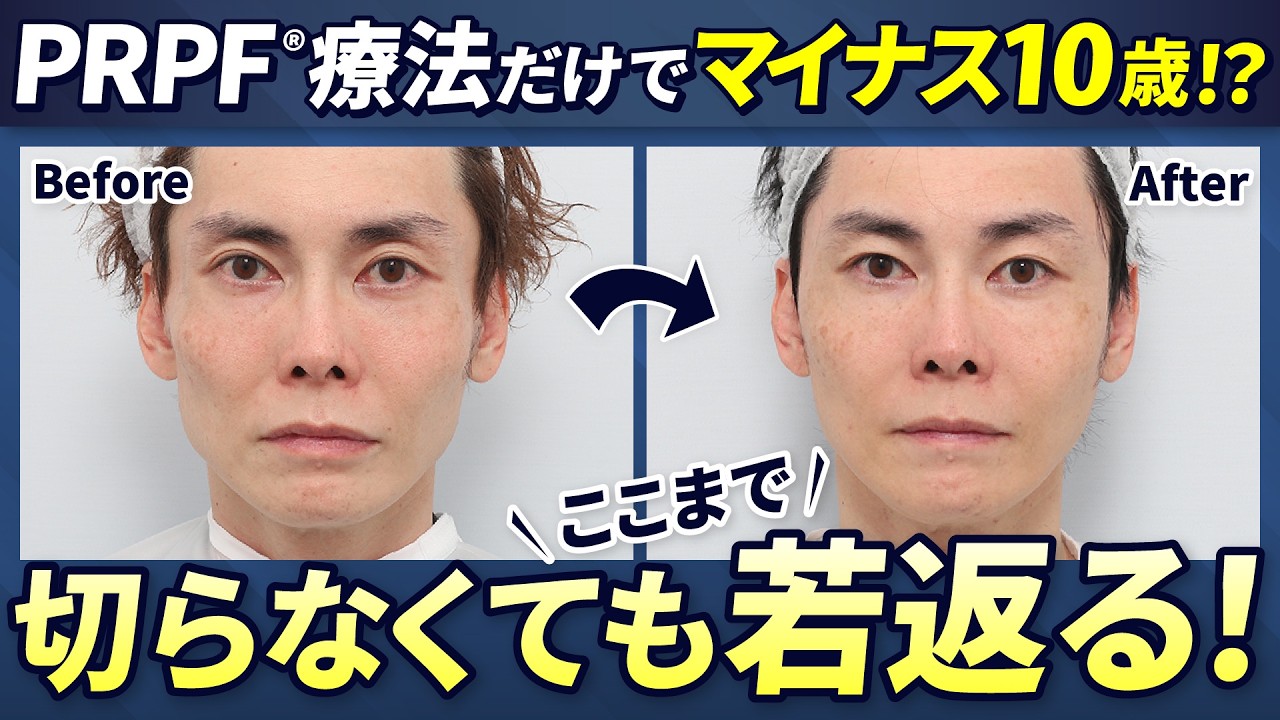 Major Transformation] Improved Jagged Facial Contour with