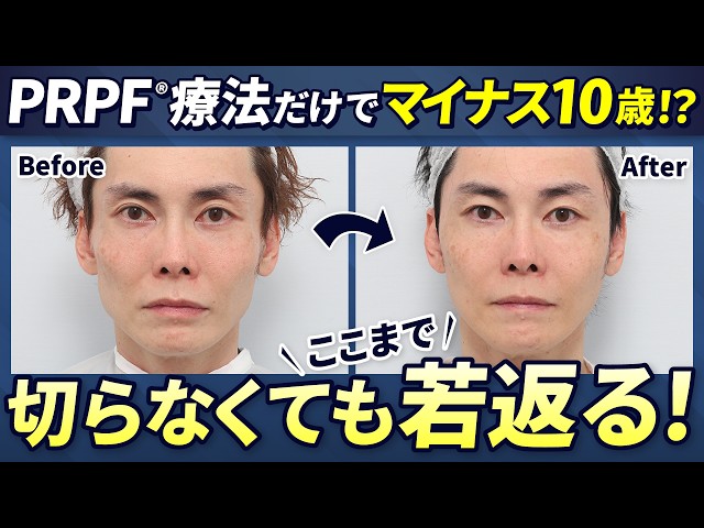Major Transformation] Improved Jagged Facial Contour with