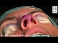 Septoplasty and Caudal Dislocation Correction: Nose Reshaping Bizrah Rhinoplasty