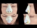 Rhinoplasty using Piezotome by Acteon