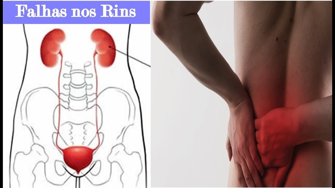 Sintomas De Rins Inflamado: Como Identificar E Tratar Essa Condição ...