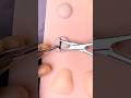 Cyst Removal Surgery 😷 #goodtoknow #vet #medicine #funfacts #surgeonlife #doctor #nurse #lifehacks