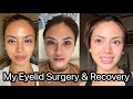 Getting Upper Blepharoplasty (Eyelid Surgery)