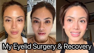 Getting Upper Blepharoplasty Eyelid Surgery