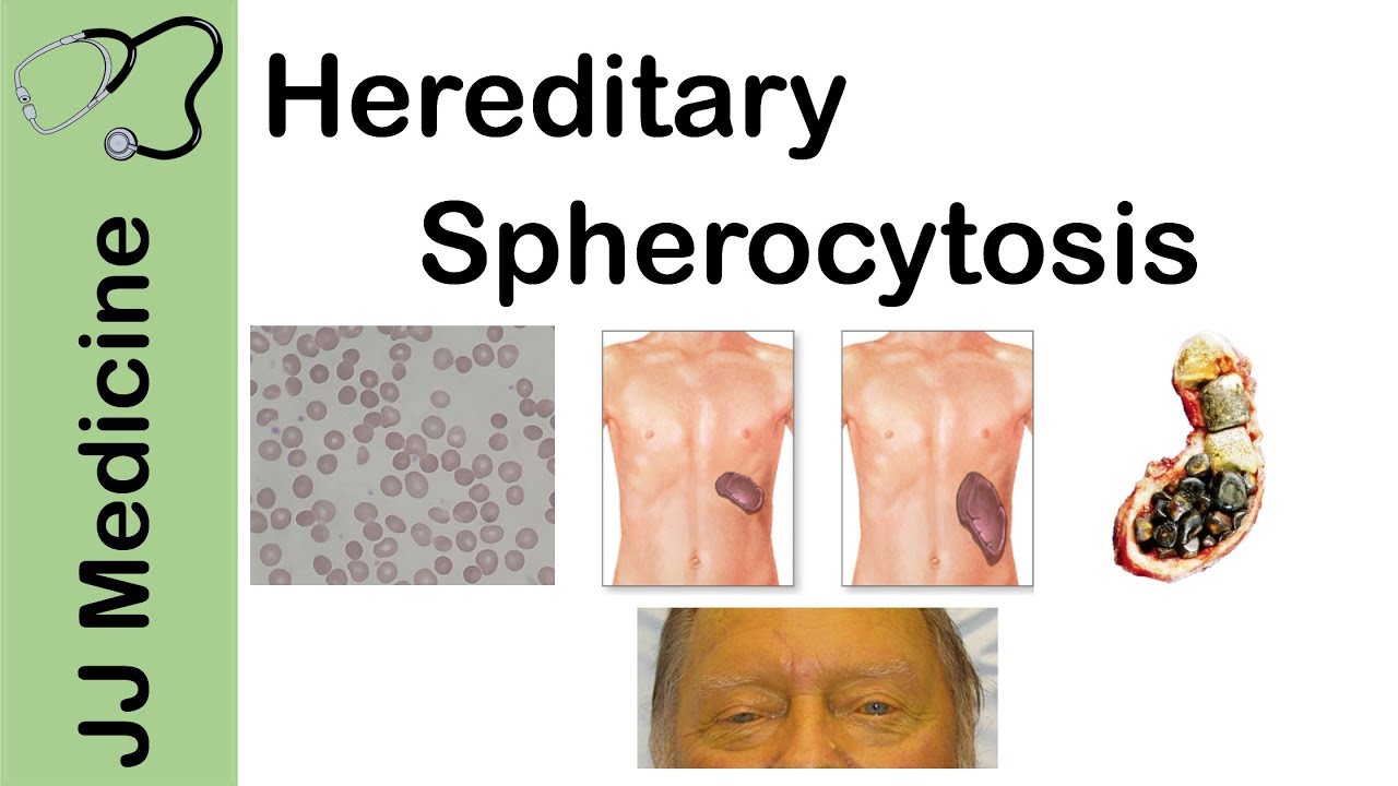 Schistosomiasis define, Schistosomiasis define - Define schistosomiasis - radiotruly.ro