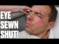 EYE SEWN SHUT AFTER SURGERY | CRAZY STITCHES AFTER SURGERY TO REMOVE MASS UNDER MY EYE