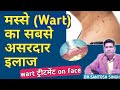 Wart ka ilaj in hindi | चेहरे के मस्से हटाने की दवा | warts treatment cream | masse ki medicine