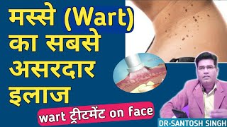 Wart ka ilaj in hindi | चेहरे के मस्से हटाने की दवा | warts treatment cream | masse ki medicine