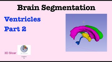 🧠 Brain Segmentation with 3D Slicer: Ventricles (part 2)