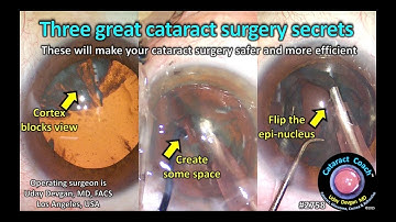 CataractCoach™ 2758: drie geweldige geheimen tegen staar!