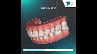 VDO Clincheck ตัวอย่าง การจัดฟันแบบใส Invisalign By Black Diamond Provider