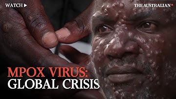 Mpox Explained: The Virus on the World’s Radar
