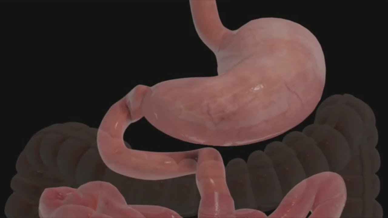 Wellness Watch: What To Know About Weight Loss Surgery