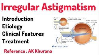 Irregular Astigmatism |AK khurana |#astigmatism #irregularastigmatism #refractiveerror #optometrist