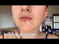 lip piercing healing process (days 1-7)