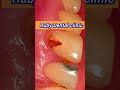 दांत के बगल में कीड़े लगना और होल होना #dental #smiledesigndental #dentist #dentalcare