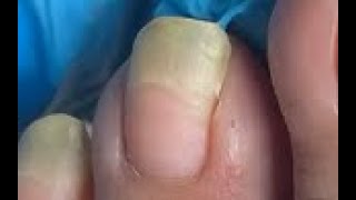 Longest toenail of the month!!!