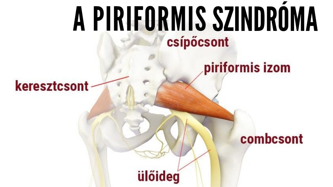 Piriformis szindróma és kezelési lehetőségei