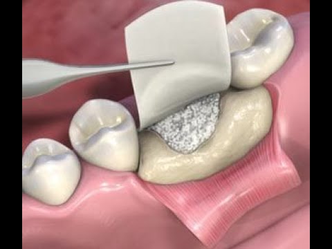 Regeneraci n Tisular Guiada En Implantolog a Oral YouTube regeneraci-n-tisular-guiada-en-implantolog-a-oral-youtube