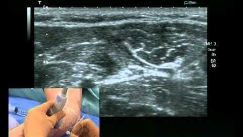 Ulnar nerve block (ultrasound guided)