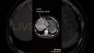 CT Abdomen #shorts #medical #abdominal #ct #learning #reels #اشعة #how #shortvideo #reel