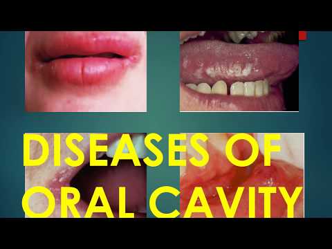 COMMON DISEASES OF ORAL CAVITY I Dental Guide I Dr. Bimal Chand I