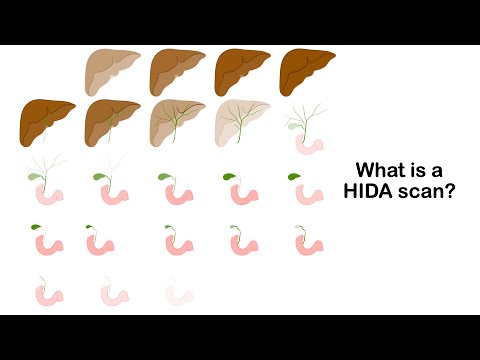 What is a HIDA scan and how is it performed