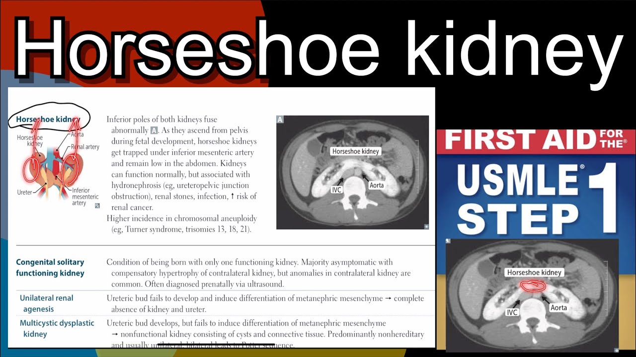 Horseshoe kidney most common kidney development anomaly in Hindi/Urdu