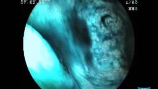 Hyperplastic Polyposis Syndrome