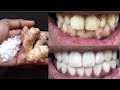 Smoking stain removal on teeth | Three Minute teeth Whitening Tip | Vanish tooth Tint removal tips