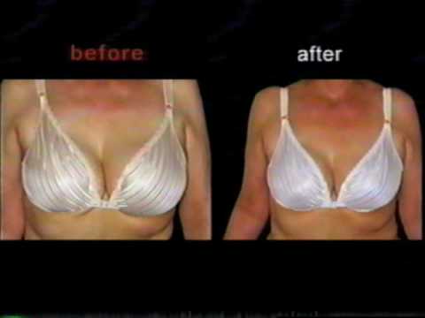 Breast Lift and Secondary Revision, Face Lift, Fat...