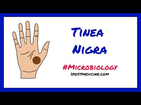 Video: Tinea Nigra: Obrázky, Příznaky A Léčba
