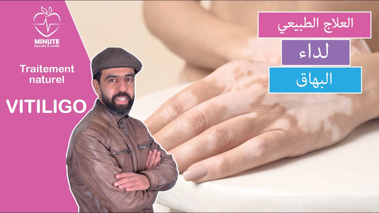 العلاج الطبيعي للبهاق ( البرص )  |  vitiligo
