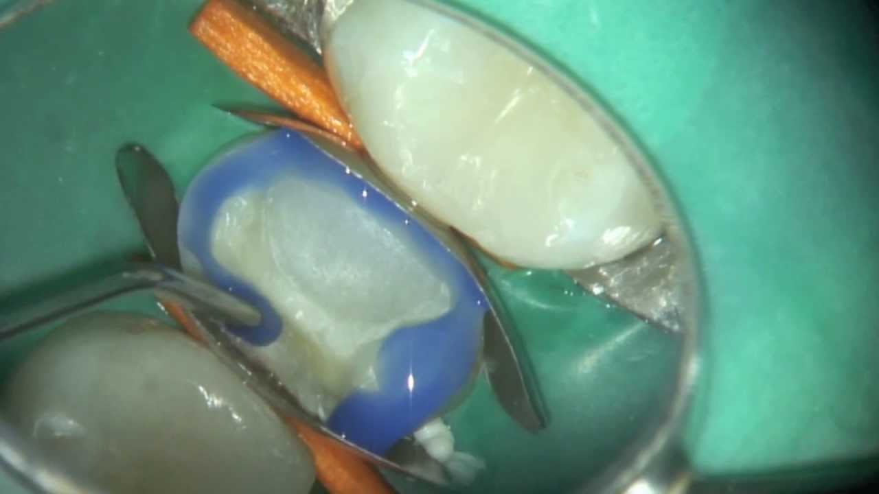 root canal filling and microscope enhanced CEREC onlay on bicuspid pt