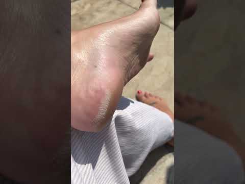 Dry heel and bug on foot