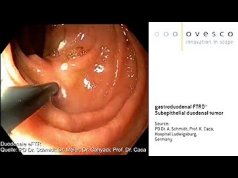 FTRD® System | gastroduodenal FTRD | Resection of a subepithelial duodenal tumor