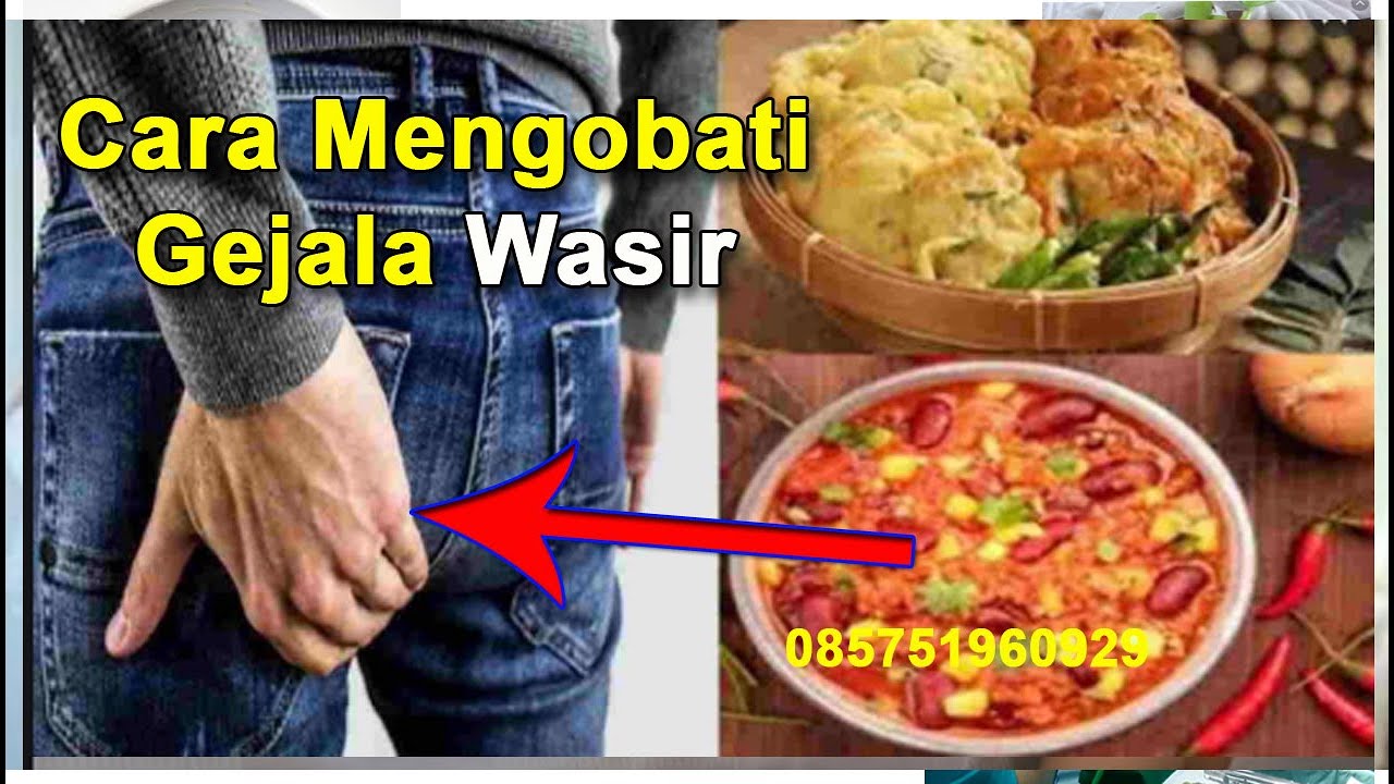 Cara Mengobati Gejala Wasir