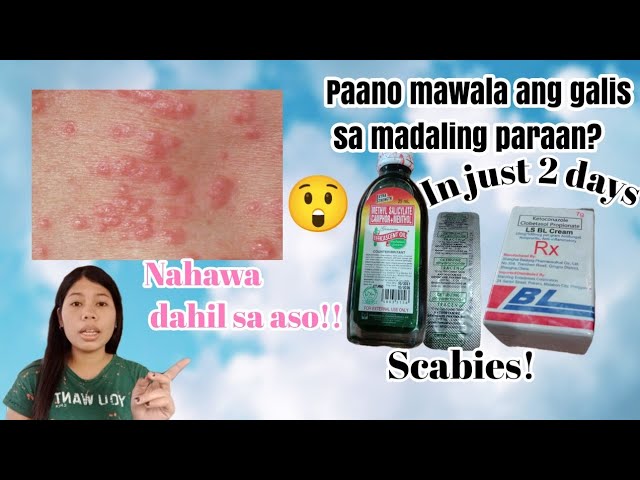 Gamot sa Scabies ng Tao: Effective Treatment