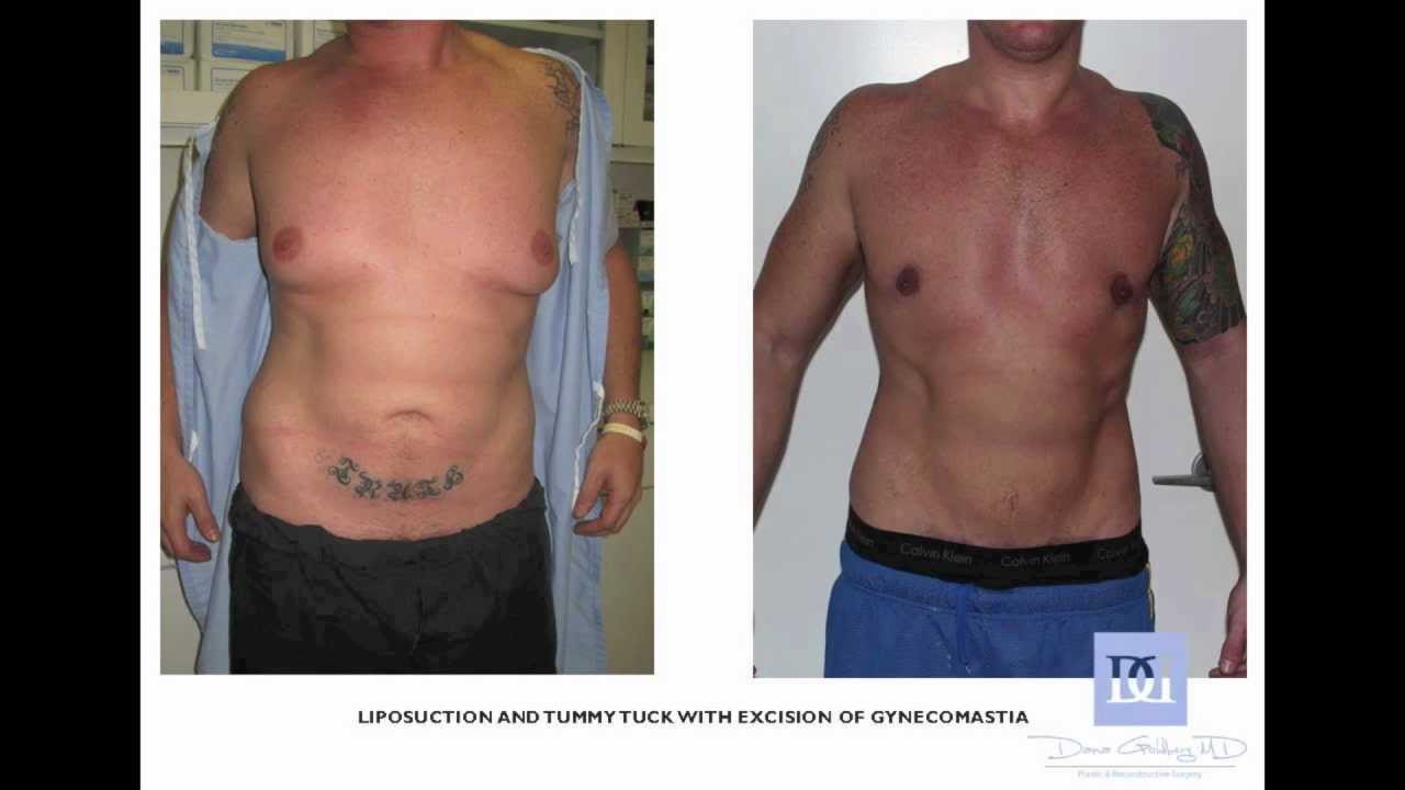 Plastic Surgery Gone Right! Tummy Tuck West Palm Beach, Palm Beach