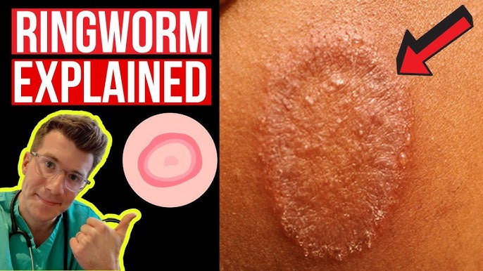 Doctor explains Scalp Ringworm (Tinea Capitis) including causes, symptoms,  treatment & more! 